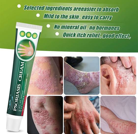 Psoriasis Relief Cream