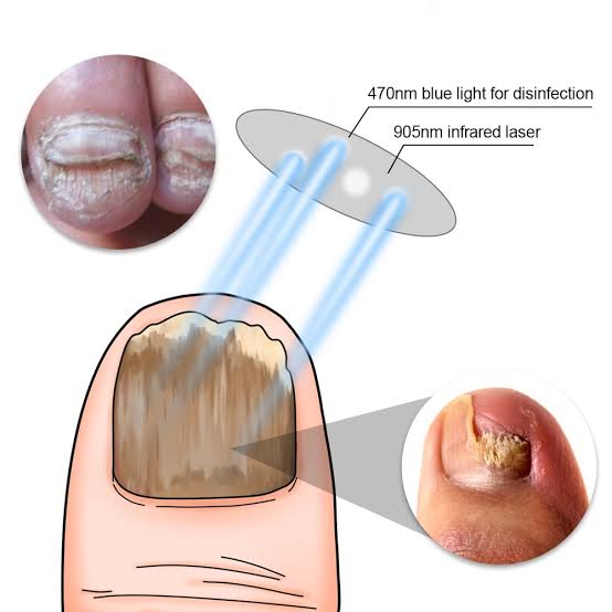 Eelhoe Fungal Nail Serum 30ml